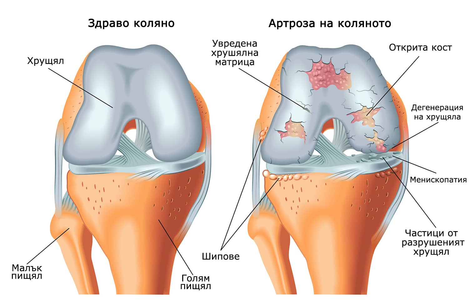 коленен артрит диаграма